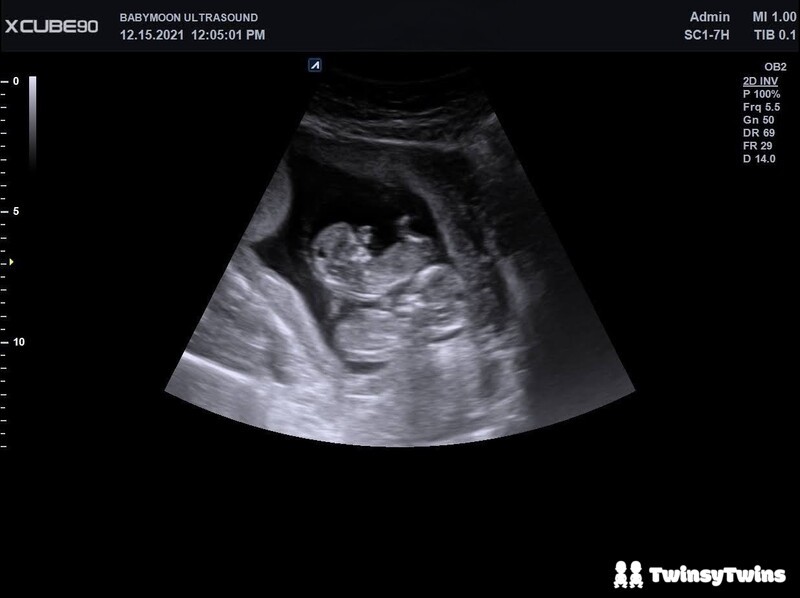 Feeling Kicks Two Months Alonng Pregnant With Identical Twins Stacked In Utero