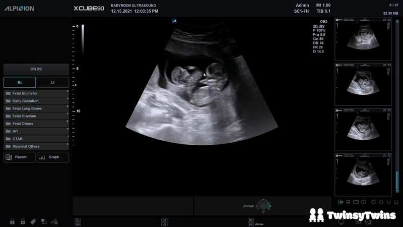 Expecting The Unexpected Moments After Finding Out Were Having Twins